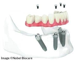 All-on-4® Dental Implants