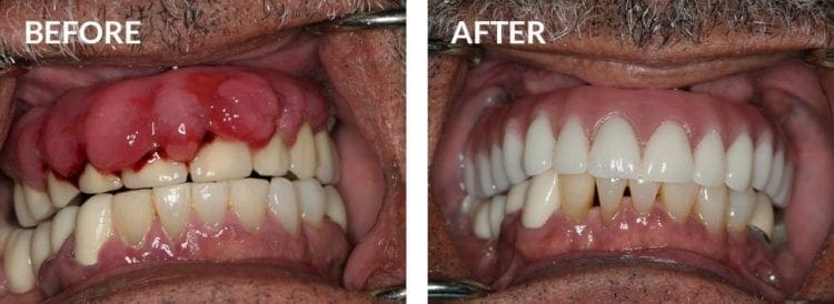 Dental Implants Before and After