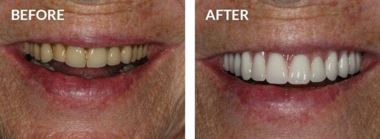 Dental Implants Before and After