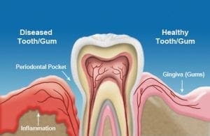 Gum Disease Chart