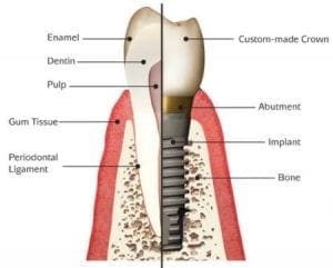 Dental Implants Tooth Chart