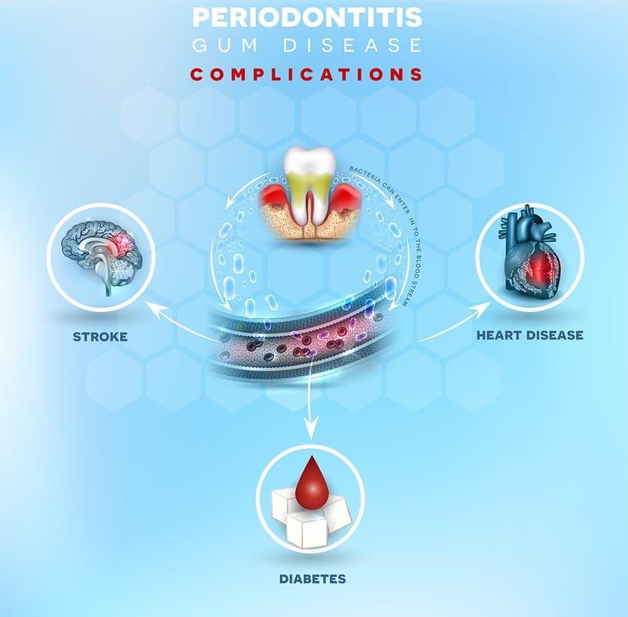 Periodontitis/Gum Disease Complications