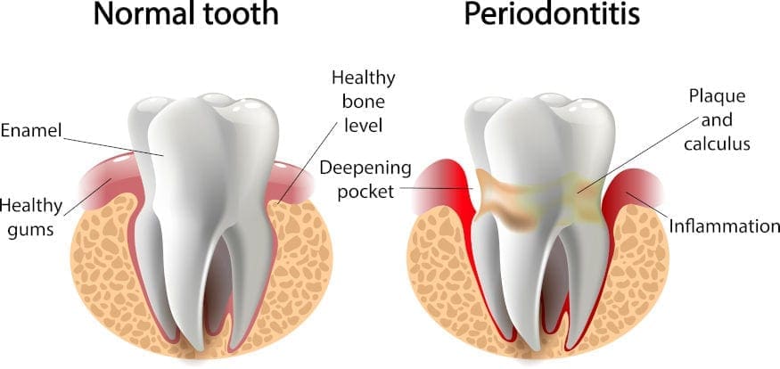 Signs of Gum Disease/Periodontitis
