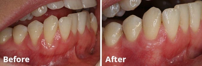 Gum Grafting Before and After