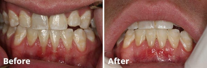 Gum Grafting Before and After