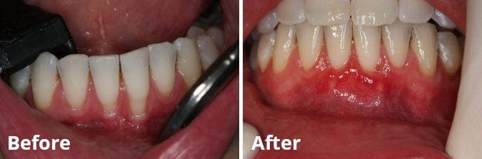 Gum Grafting Before and After