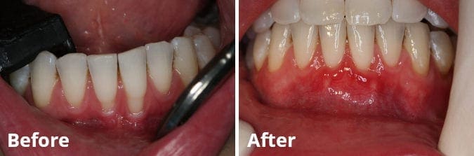 receding gums surgery before and after