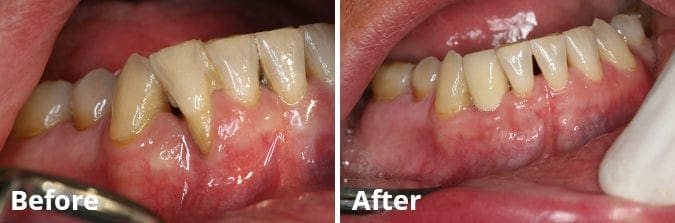 Gum Grafting Before and After