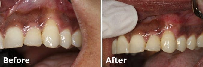 Gum Grafting Before and After