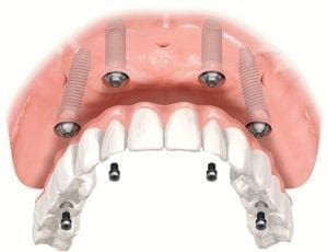 All on 4 Dental Implants Graphic